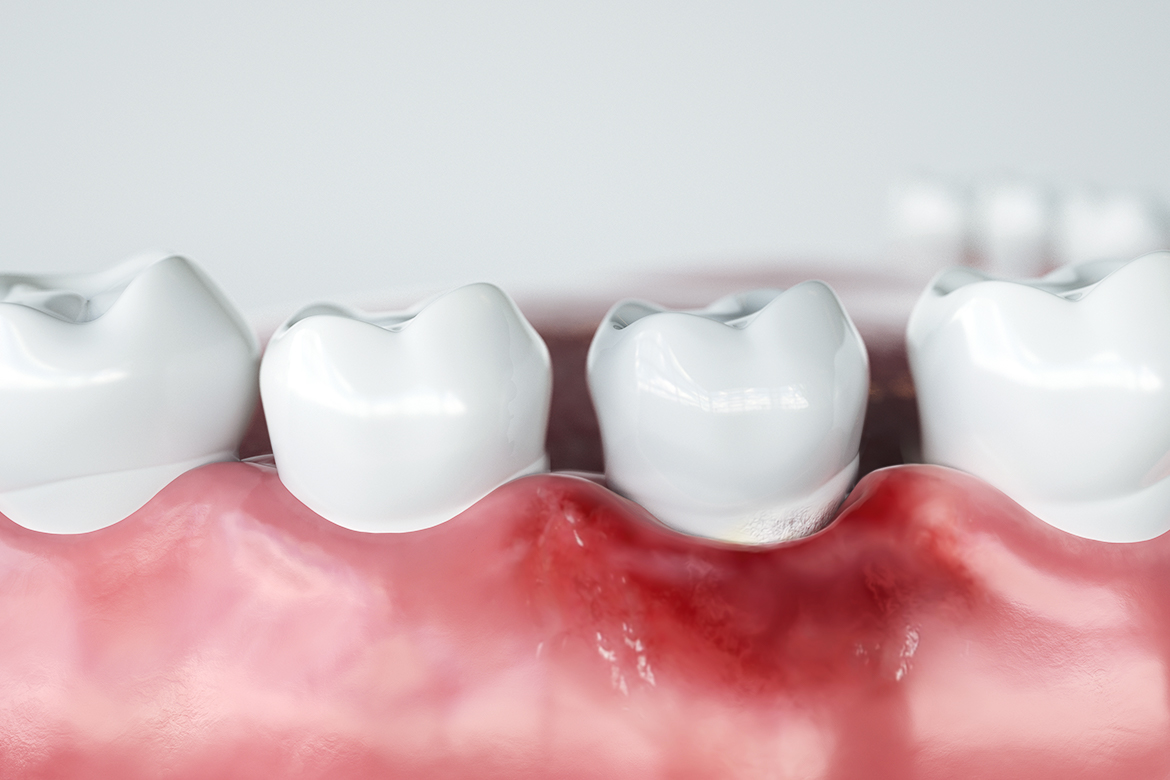 一日假牙One Day Crown[基隆澄星。麗星牙醫診所]